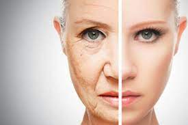 Differenza tra un volto di donna prima e dopo l'utilizzo del filler